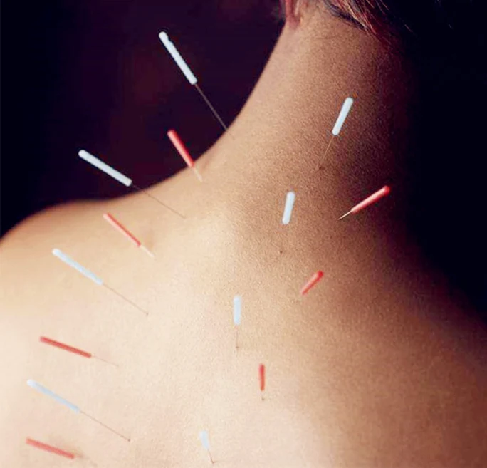 Acupuncture therapy at Tapasya Health & Wellness